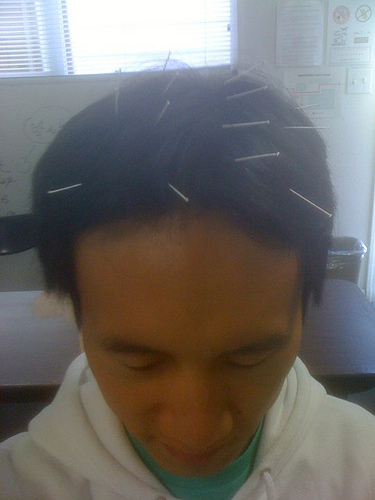 acupuncture